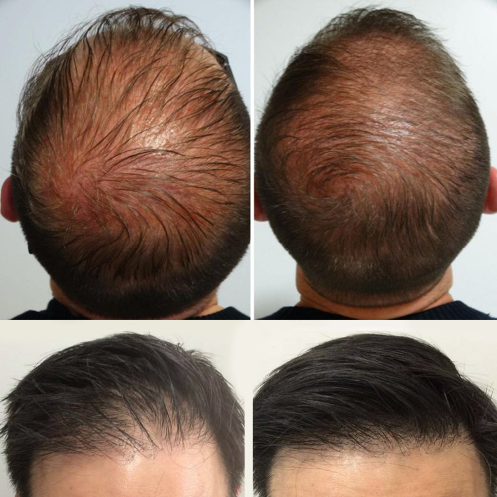 mezoterapija-hyaluron-ampule-i-derma-roler